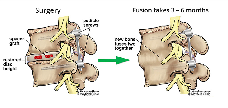 spinal fusion takes 3-6 months