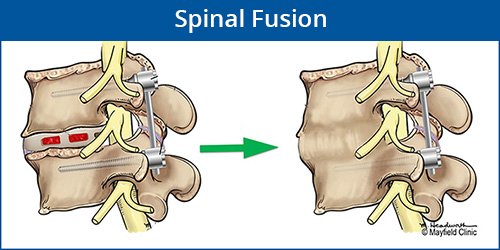 Spine Fusion Class