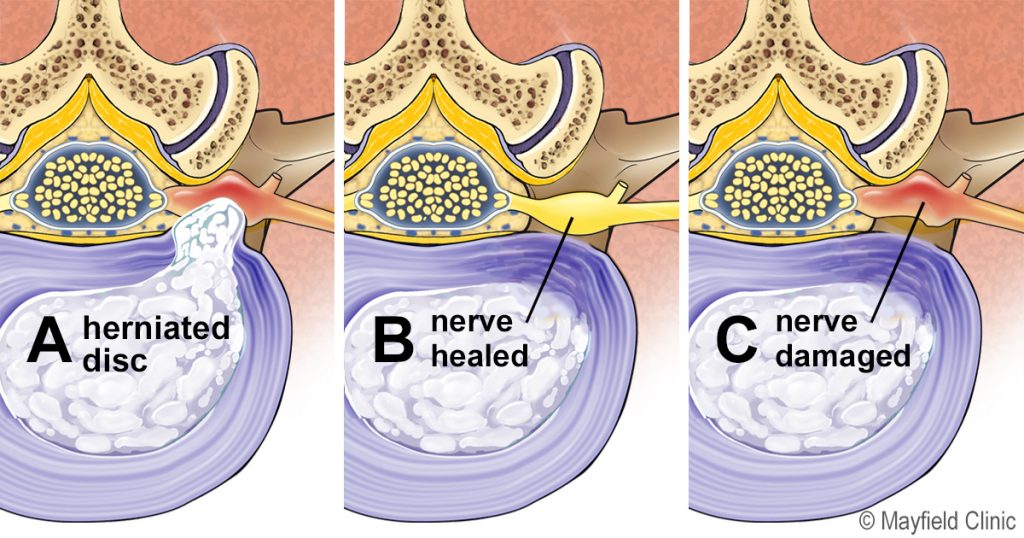 kold Efterforskning Defekt Understanding nerve pain after spine surgery – Mayfield Brain & Spinal  Column