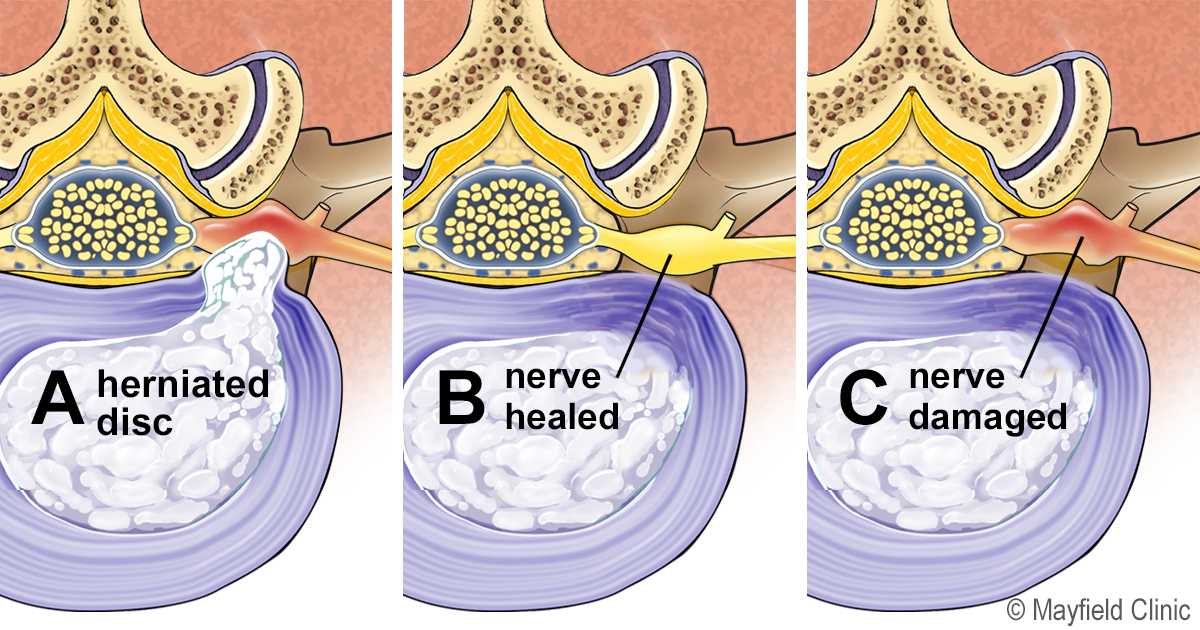 What helps nerve pain in leg after back surgery?