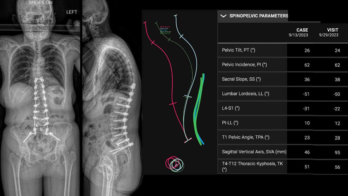 scoliosis case example of UNiD Adaptive Spine platform